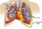 MESOTHELIOMA, Causes, Signs and Symptoms, Diagnosis and Treatment.