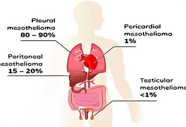mesothelioma va claim, best mesothelioma lawyers us navy veteran, mesothelioma firm, pleural mesothelioma diagnosis
